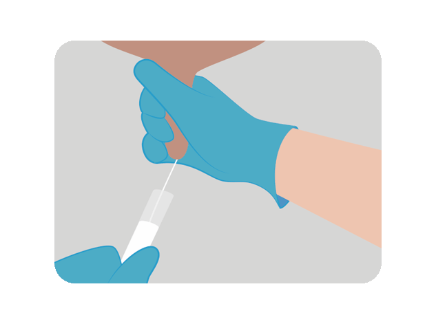 Stage 1 Mastitis in cows first signs of mastitis in cows